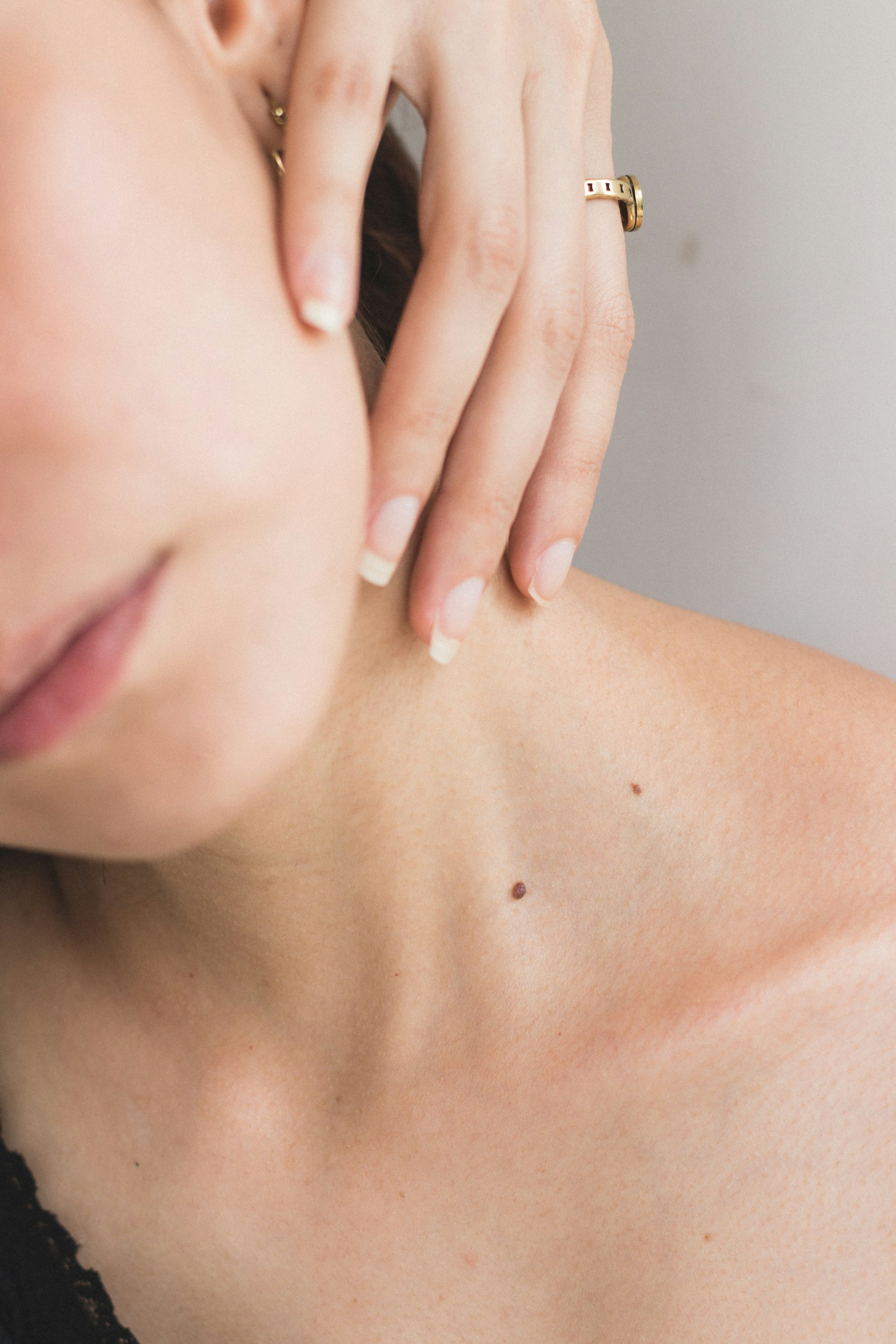 Chin Liposuction (Double Chin Removal)
